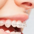 What Activities Should I Avoid When Getting My Teeth Straightened?